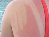Sonnenbrand